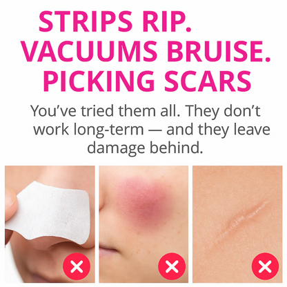 PoreLift Blackhead Remover Vacuum